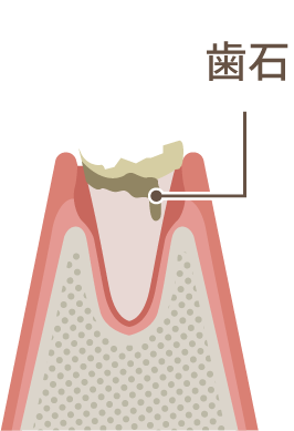 歯石の付着した歯のイラスト