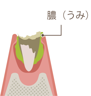 膿の溜まった歯のイラスト